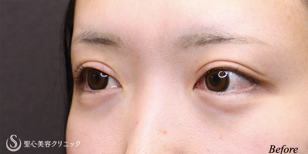 【20代女性・ハム目を解消】睫毛上皮膚切除（1週間後） Before 