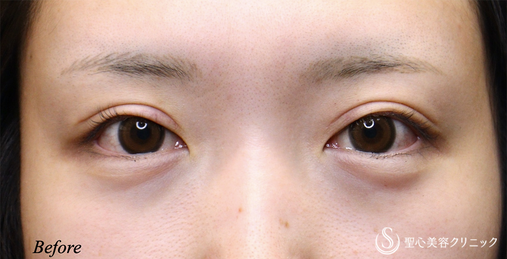 【20代女性・ハム目を解消】睫毛上皮膚切除（1週間後） Before 