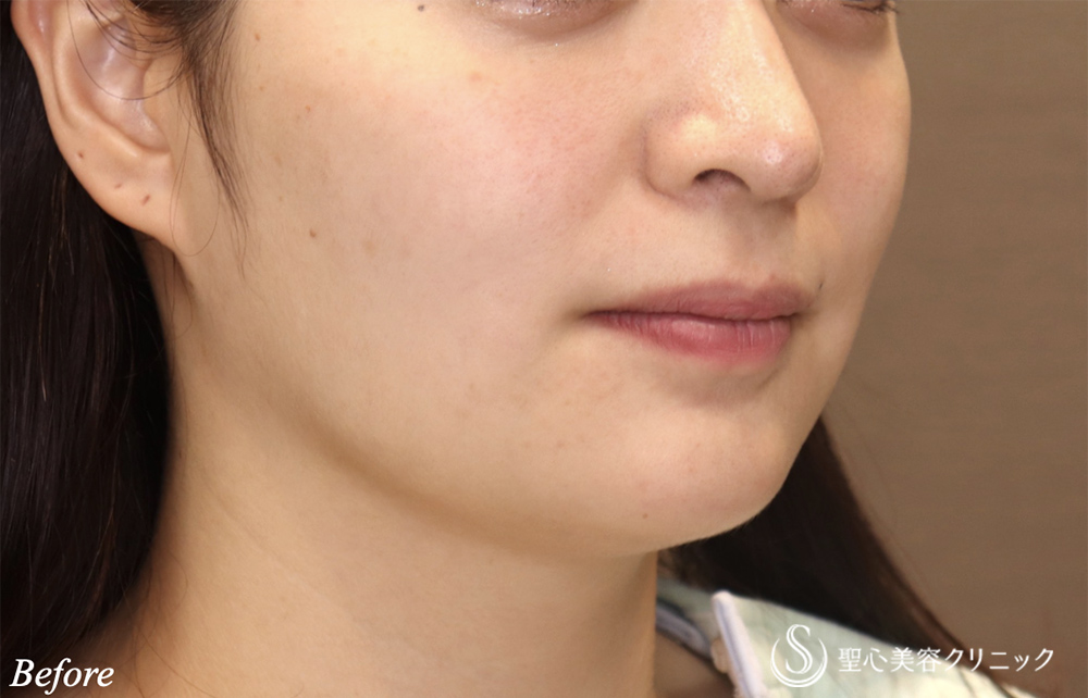 【30代女性・フェイスラインがすっきり】脂肪吸引注射（頬＋顎下）（2ヶ月後） Before 