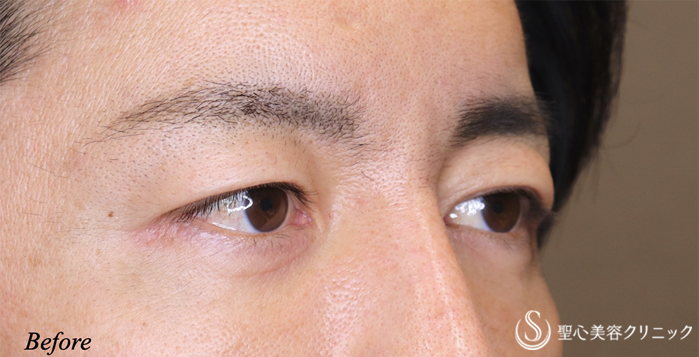 【40代男性・目元をスッキリ】眉下リフト（7ヶ月後） Before 