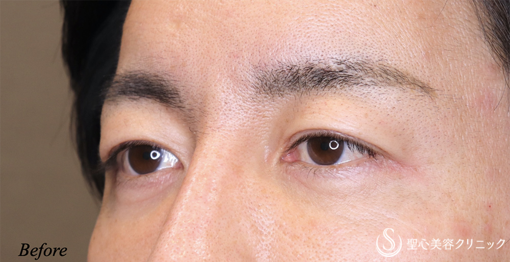 【40代男性・目元をスッキリ】眉下リフト（7ヶ月後） Before 