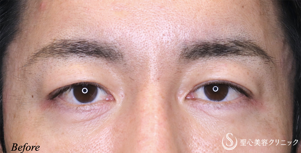 【40代男性・目元をスッキリ】眉下リフト（7ヶ月後） Before 