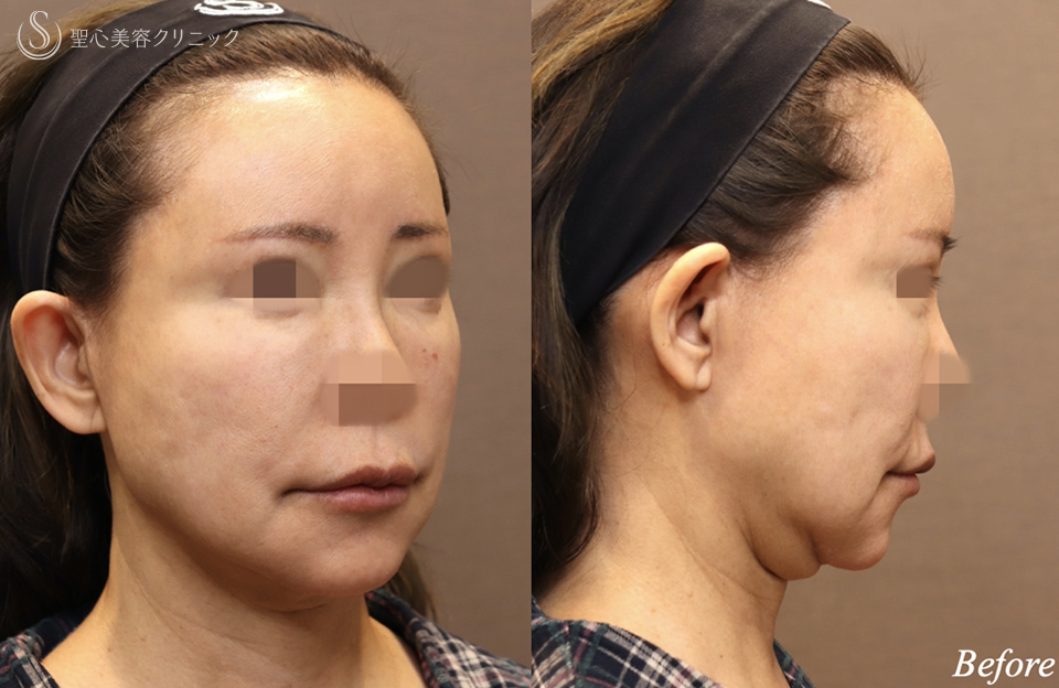 【60代女性・顎下のラインシャープに】フェイスリフト＋ネックリフト＋ペリカンリフト（術後3ヶ月） Before 
