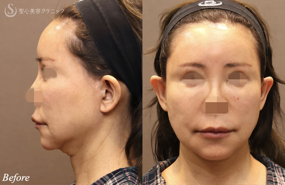 【60代女性・顎下のラインシャープに】フェイスリフト＋ネックリフト＋ペリカンリフト（術後3ヶ月） Before 