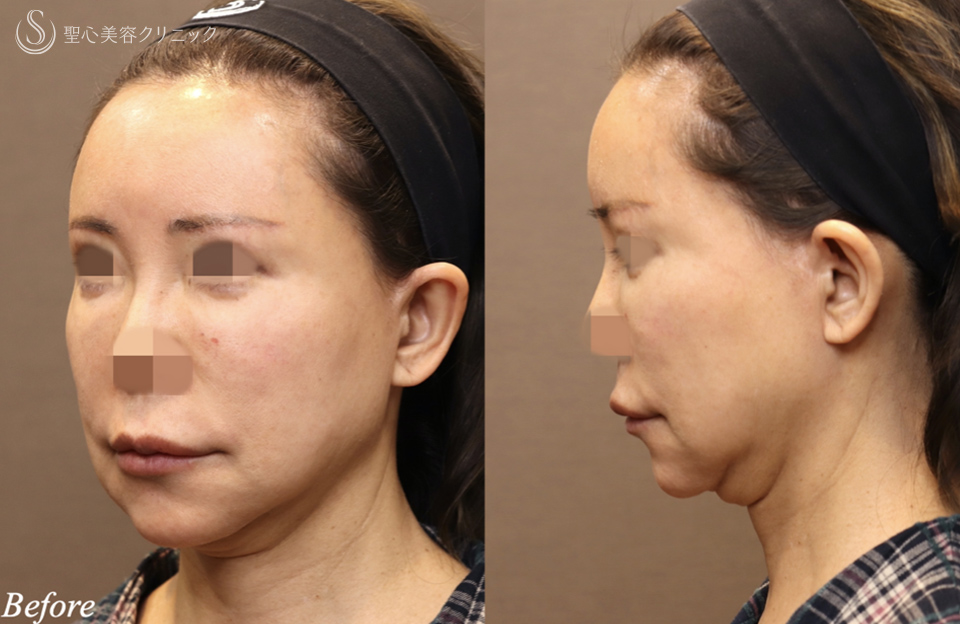 【60代女性・顎下のラインシャープに】フェイスリフト＋ネックリフト＋ペリカンリフト（術後3ヶ月） Before 