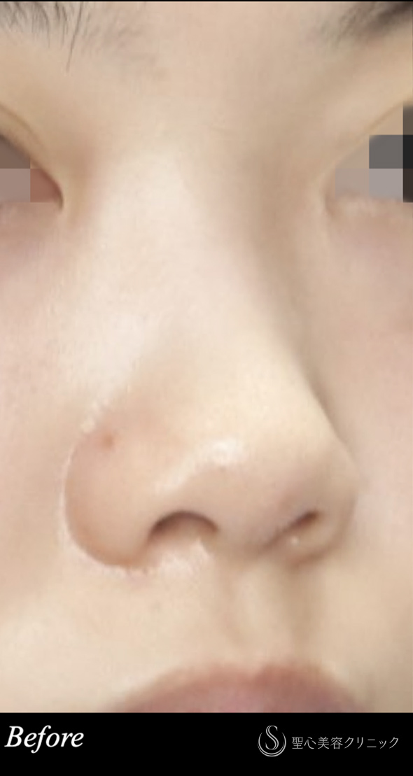 【20代女性・小さくナチュラルな鼻】　鼻尖形成（ストラット法）＋耳介軟骨移植後（1ヶ月後） Before 