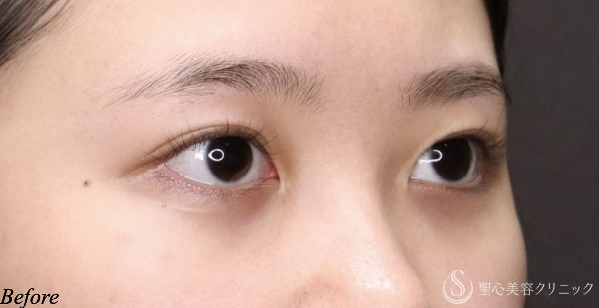 【20代女性・二重幅を自然に広げたい】目上切開（埋没法）（術後9ヶ月） Before 