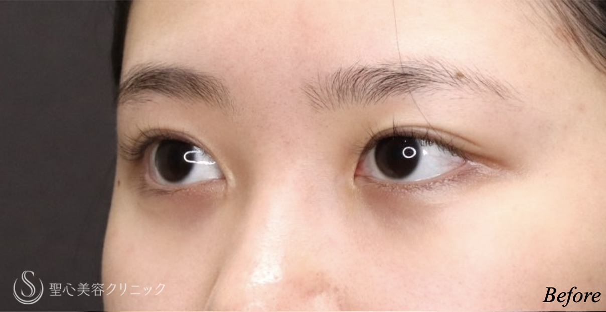 【20代女性・二重幅を自然に広げたい】目上切開（埋没法）（術後9ヶ月） Before 