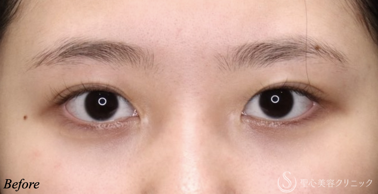 【20代女性・二重幅を自然に広げたい】目上切開（埋没法）（術後9ヶ月） Before 