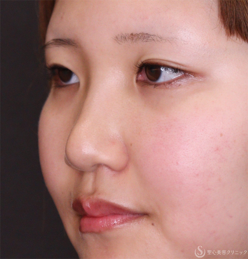【20代女性・蒙古ひだ改善】目頭切開（3ヶ月後） Before 