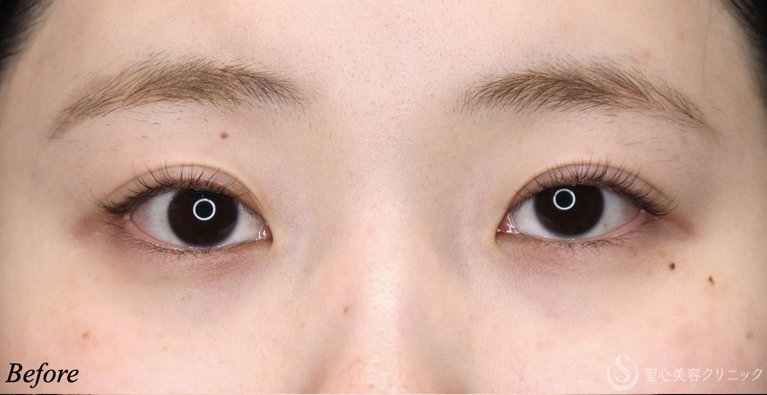 【20代女性・理想の目元に】目上切開（術後3ヶ月） Before 