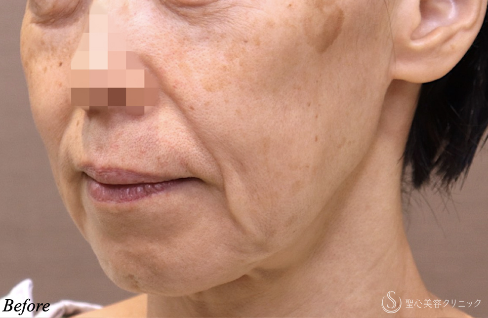 【50代女性・確実に若返る】フェイスリフト＋ネックリフト＋リガメント処置＋頬・顎下の脂肪吸引（術後3ヶ月） Before 