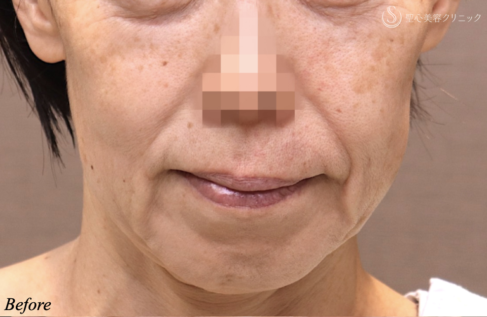 【50代女性・確実に若返る】フェイスリフト＋ネックリフト＋リガメント処置＋頬・顎下の脂肪吸引（術後3ヶ月） Before 