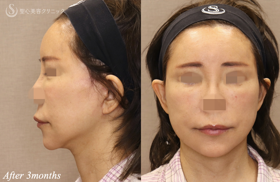 【60代女性・顎下のラインシャープに】フェイスリフト＋ネックリフト＋ペリカンリフト（術後3ヶ月） After 