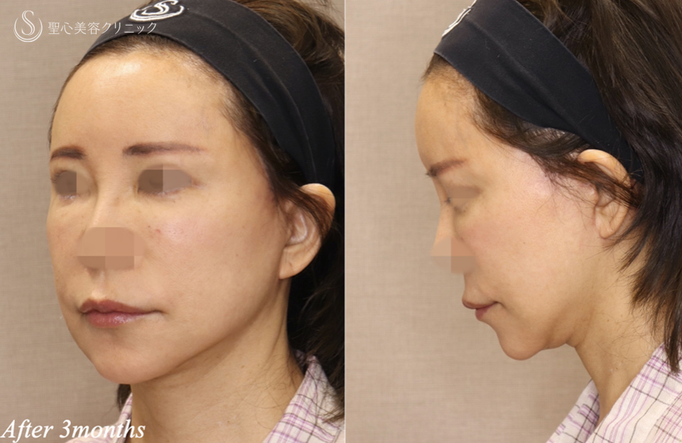 【60代女性・顎下のラインシャープに】フェイスリフト＋ネックリフト＋ペリカンリフト（術後3ヶ月） After 