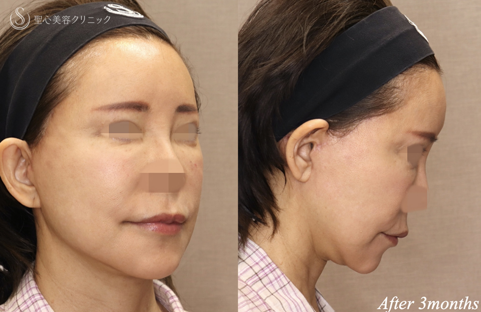 【60代女性・顎下のラインシャープに】フェイスリフト＋ネックリフト＋ペリカンリフト（術後3ヶ月） After 