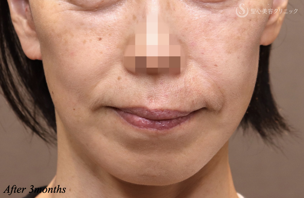 【50代女性・確実に若返る】フェイスリフト＋ネックリフト＋リガメント処置＋頬・顎下の脂肪吸引（術後3ヶ月） After 