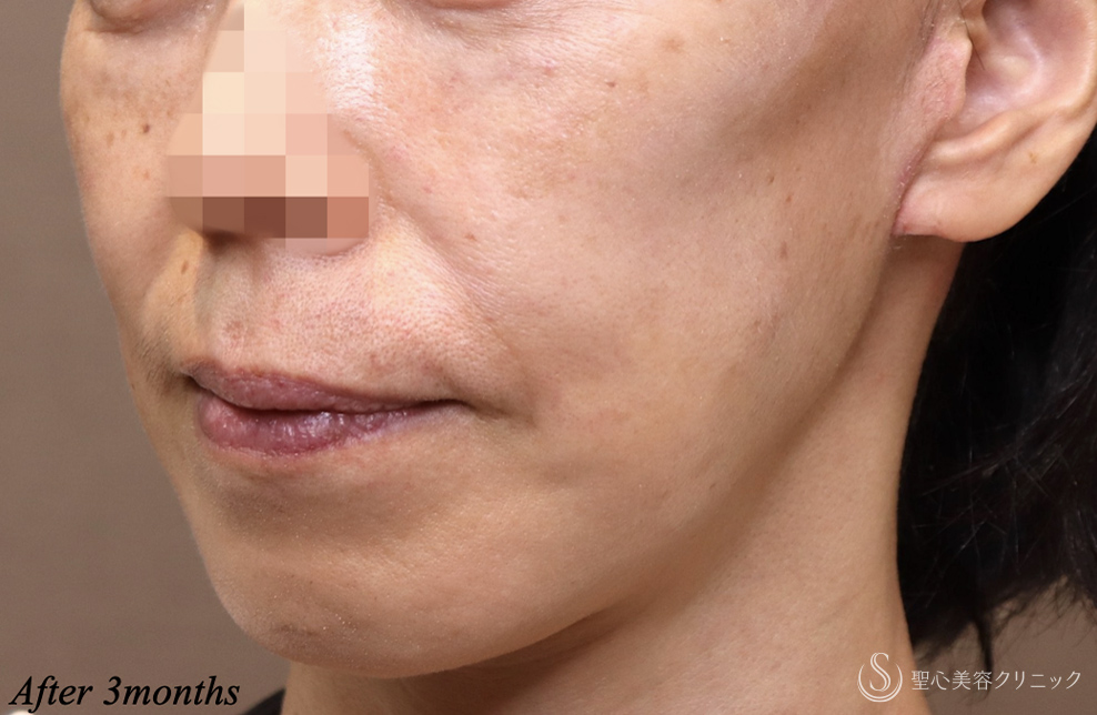 【50代女性・確実に若返る】フェイスリフト＋ネックリフト＋リガメント処置＋頬・顎下の脂肪吸引（術後3ヶ月） After 