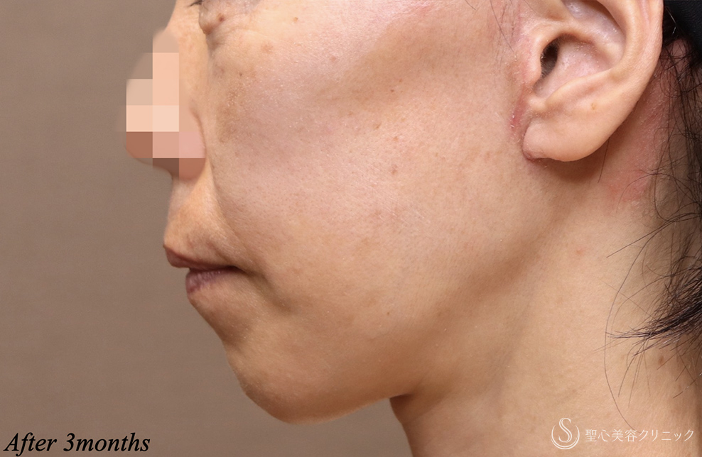【50代女性・確実に若返る】フェイスリフト＋ネックリフト＋リガメント処置＋頬・顎下の脂肪吸引（術後3ヶ月） After 