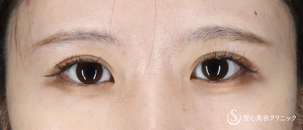 【20代女性・埋没で奥二重をしっかり二重に】二重術（埋没法）マイクロメソッド+α（1ヶ月後） After 