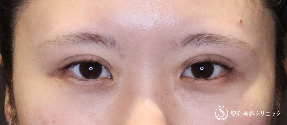 【20代女性・埋没で奥二重をしっかり二重に】二重術（埋没法）マイクロメソッド+α（1ヶ月後） After 