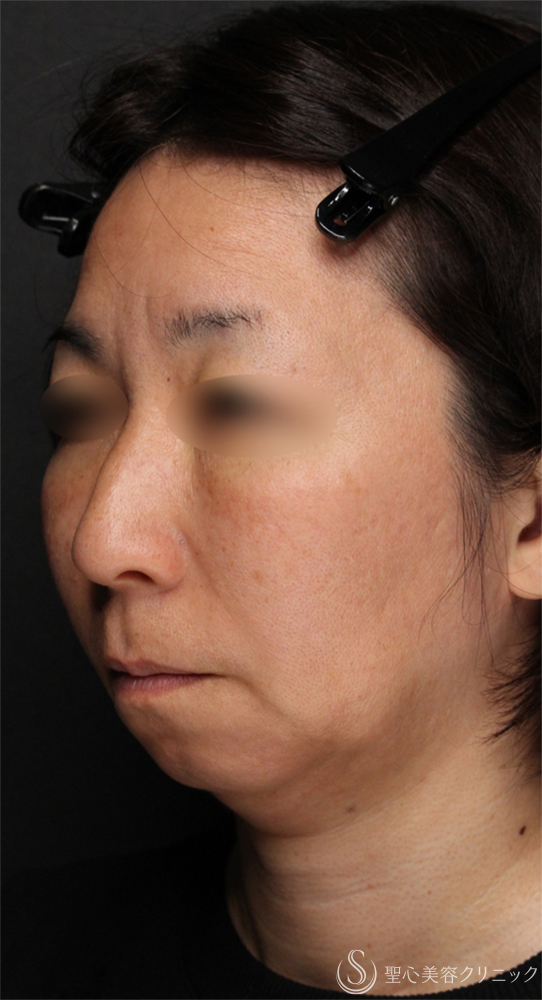 【50代女性・ヒアルロン酸で切らない若返りリフト】トータルフェイシャルトリートメント（直後） Before 