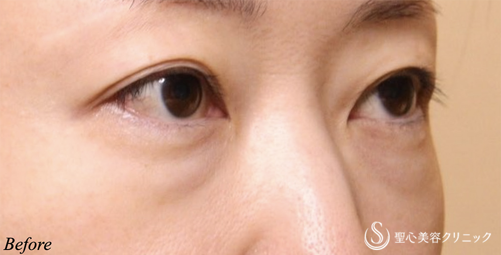 【40代女性・目の下の膨らみ】経結膜脱脂術（1ヶ月後） Before 