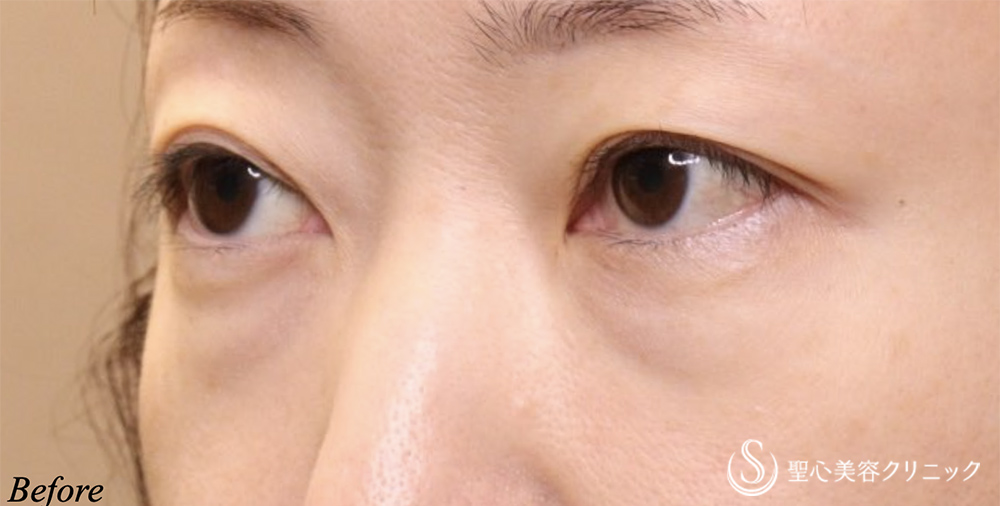 【40代女性・目の下の膨らみ】経結膜脱脂術（1ヶ月後） Before 