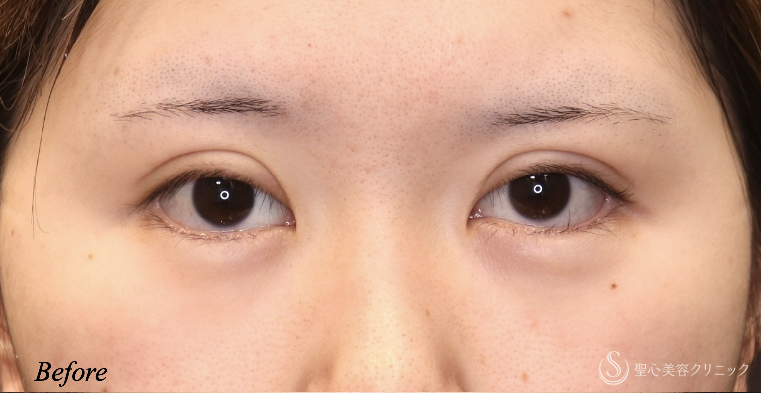 【20代女性・ハム目を治す】睫毛上皮膚切除（術後1ヶ月） Before 