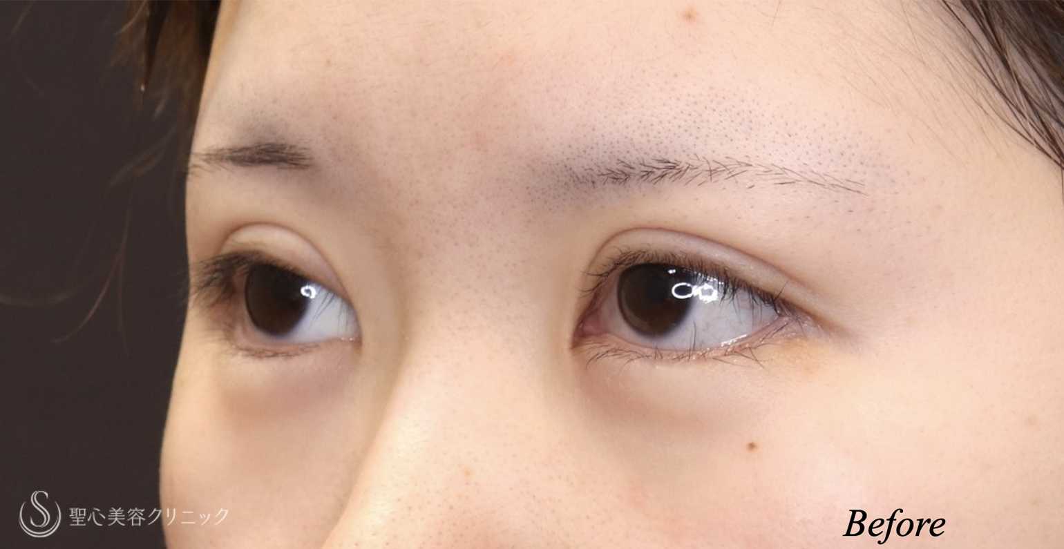【20代女性・ハム目を治す】睫毛上皮膚切除（術後1ヶ月） Before 