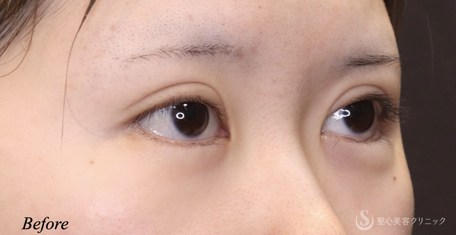 【20代女性・ハム目を治す】睫毛上皮膚切除（術後1ヶ月） Before 