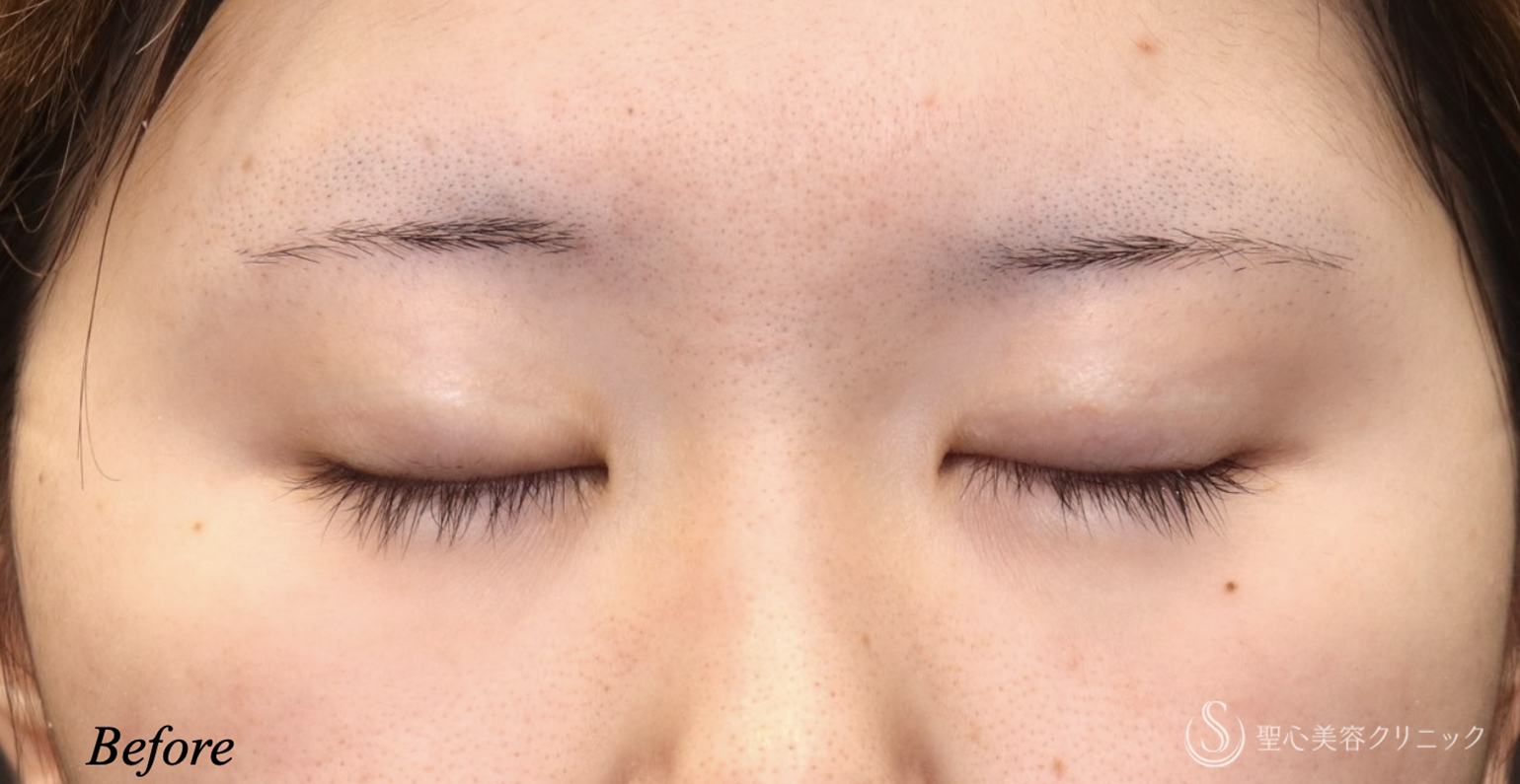 【20代女性・ハム目を治す】睫毛上皮膚切除（術後1ヶ月） Before 