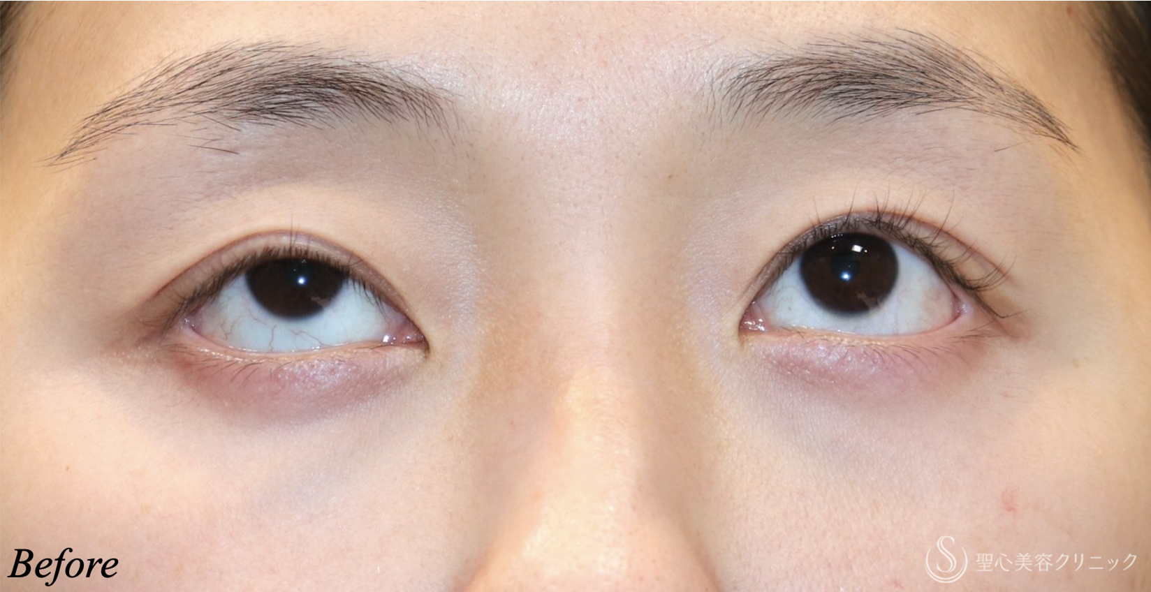 【20代女性・目の開きを大きく】　眼瞼下垂（埋没法）（直後） Before 