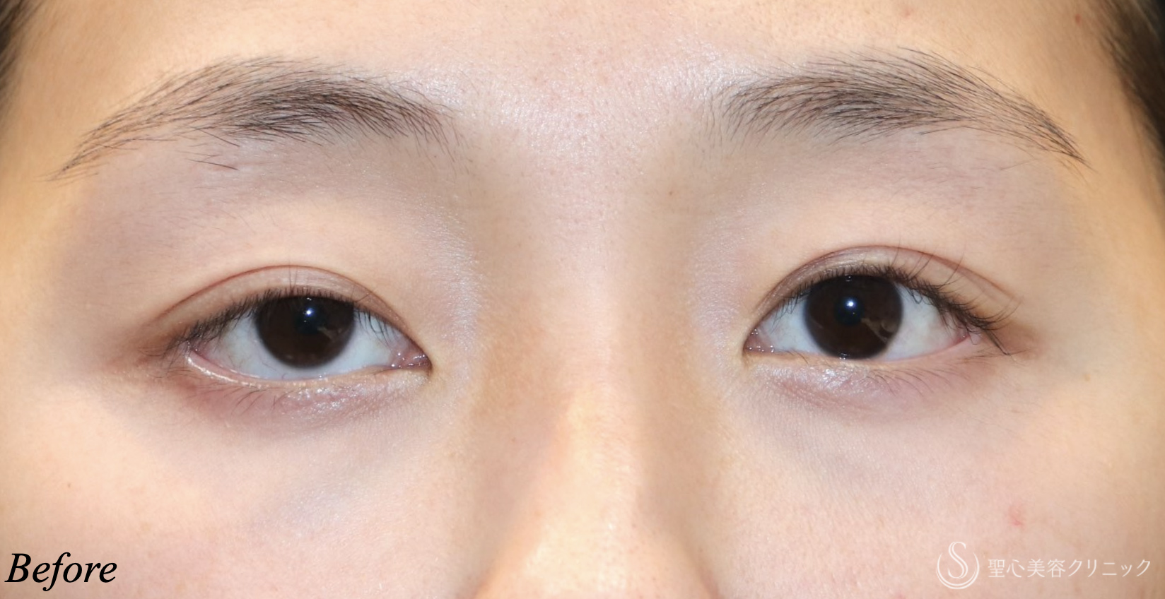 【20代女性・目の開きを大きく】　眼瞼下垂（埋没法）（直後） Before 