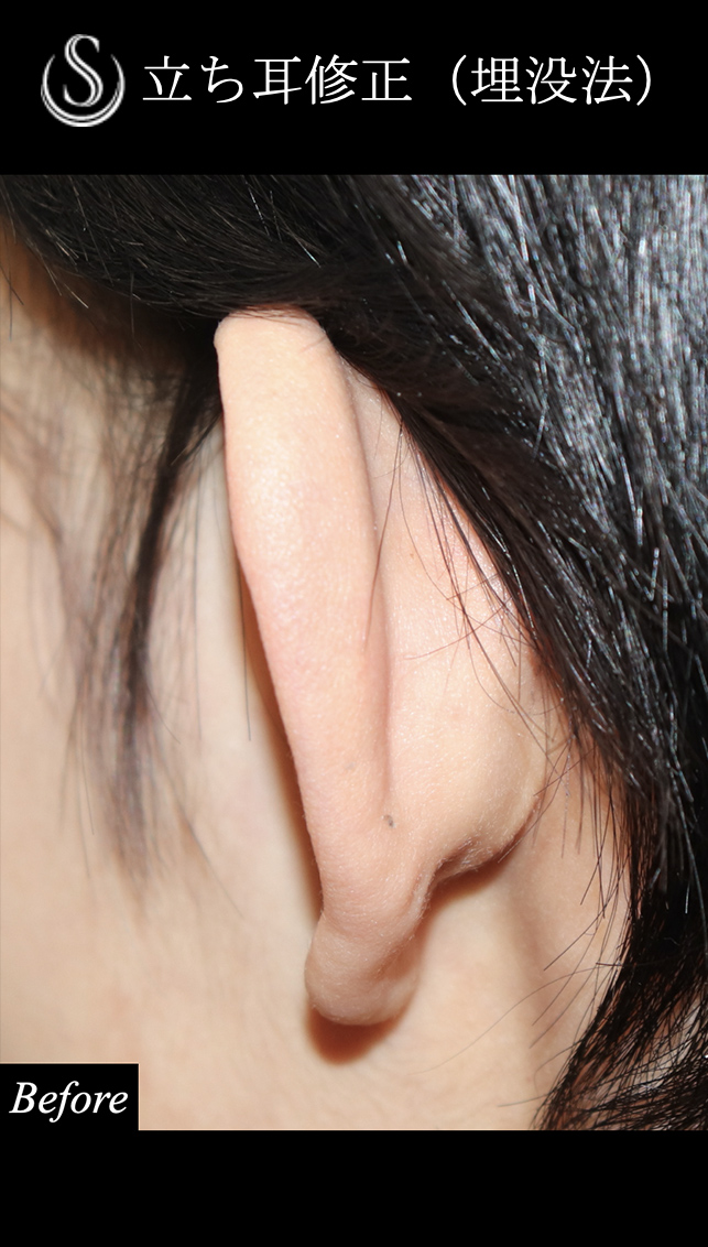 【20代女性・立った耳を寝かせる】　立ち耳修正（埋没法）（1ヶ月後） Before 