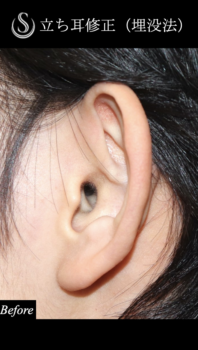 【20代女性・立った耳を寝かせる】　立ち耳修正（埋没法）（1ヶ月後） Before 
