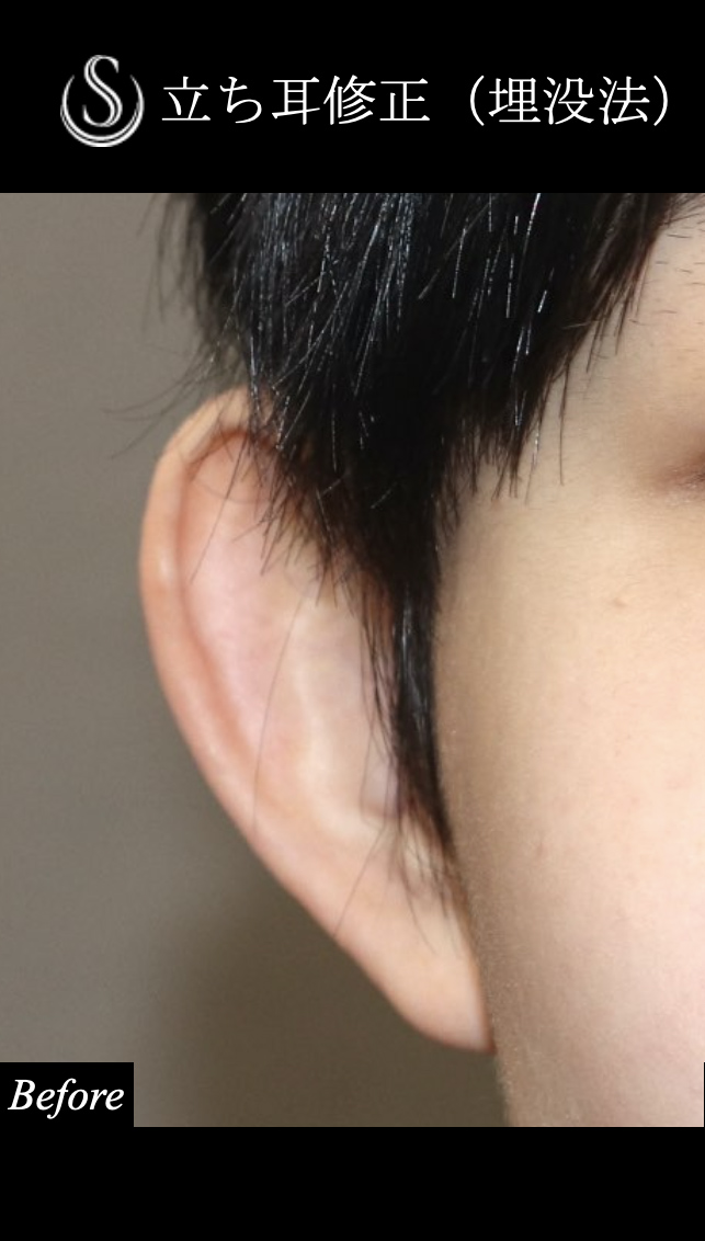 【20代女性・立った耳を寝かせる】　立ち耳修正（埋没法）（1ヶ月後） Before 