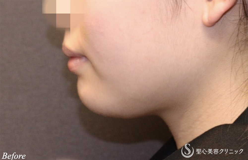 【20代女性・頬と顎下のもたつき】脂肪吸引注射（頬＋顎）（6ヵ月後） Before 