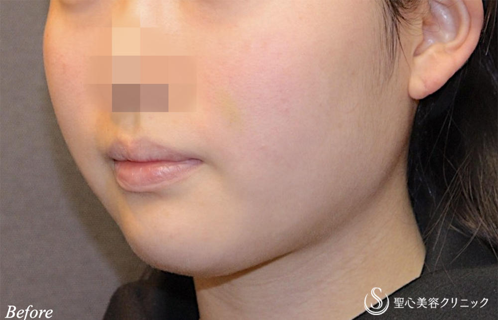 【20代女性・頬と顎下のもたつき】脂肪吸引注射（頬＋顎）（6ヵ月後） Before 