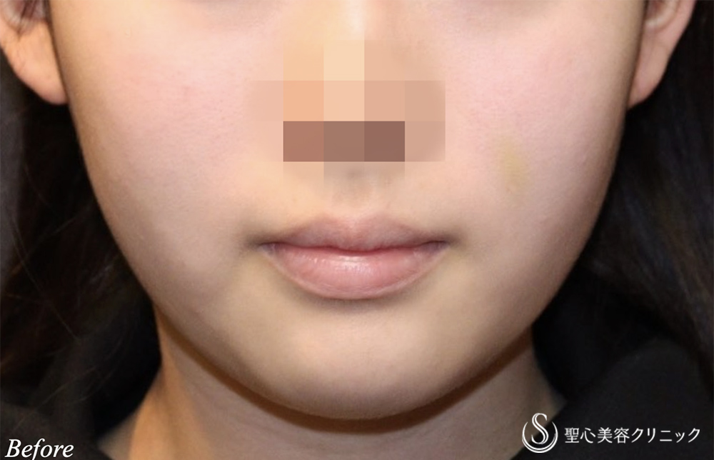 【20代女性・頬と顎下のもたつき】脂肪吸引注射（頬＋顎）（6ヵ月後） Before 