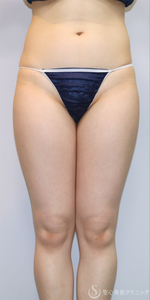 【20代女性・一回りスリムな脚へ】ベイザーリポ2.2脂肪吸引（大腿全周・臀部）（3ヶ月後） Before 