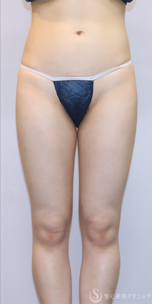【20代女性・一回りスリムな脚へ】ベイザーリポ2.2脂肪吸引（大腿全周・臀部）（3ヶ月後） After 名古屋・部分痩せ