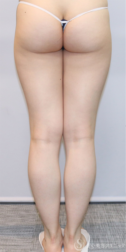 【20代女性・一回りスリムな脚へ】ベイザーリポ2.2脂肪吸引（大腿全周・臀部）（3ヶ月後） Before 