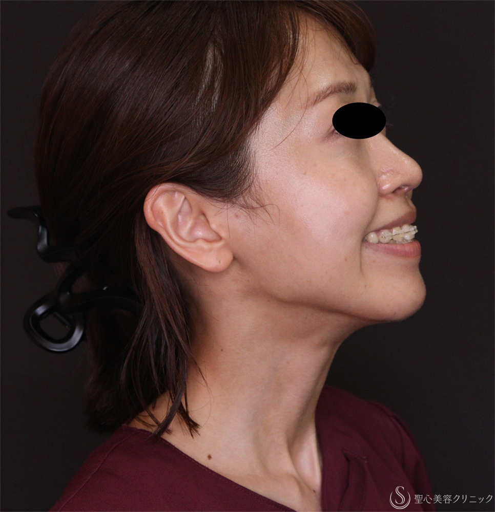 【20代女性・綺麗な首筋に】ボトックスリフト（4日後） After 