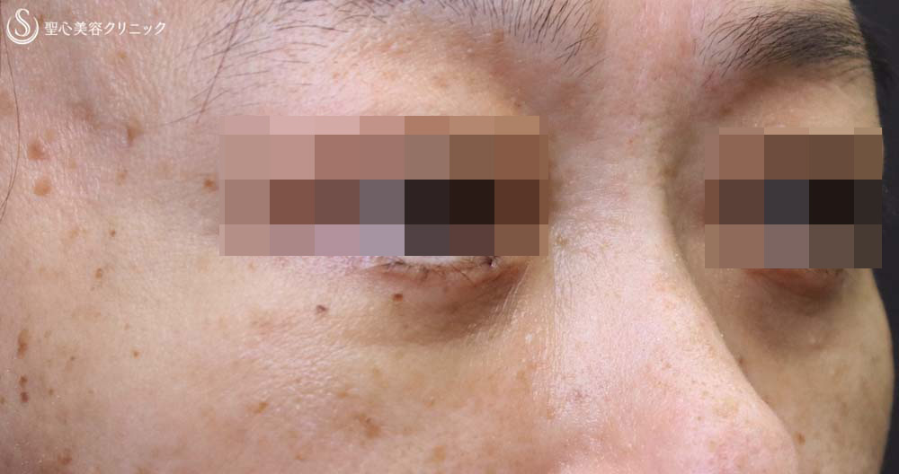 【50代女性・大きなクマをスッキリ解消】下眼瞼切開術/下眼瞼除皺術/ハムラ法（術後1ヶ月） After 