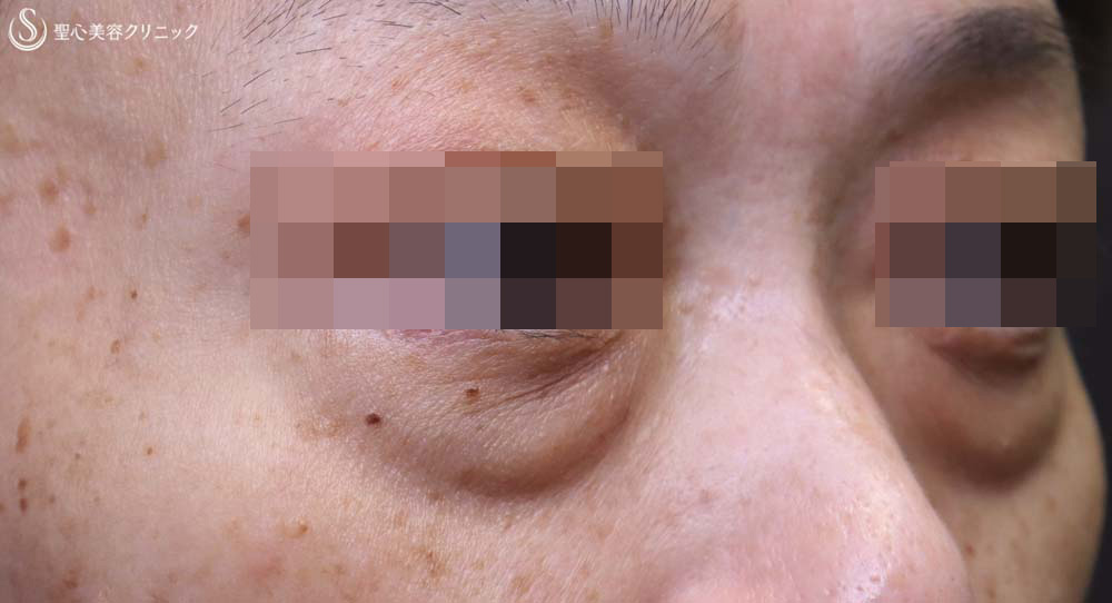 【50代女性・大きなクマをスッキリ解消】下眼瞼切開術/下眼瞼除皺術/ハムラ法（術後1ヶ月） Before 