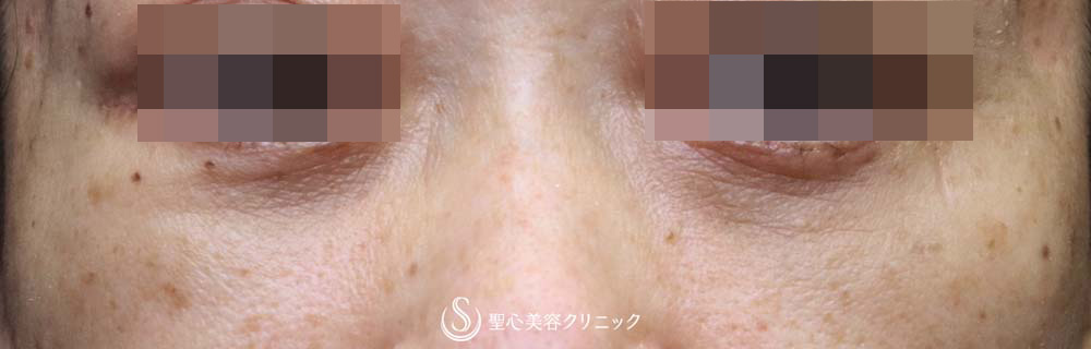 【50代女性・大きなクマをスッキリ解消】下眼瞼切開術/下眼瞼除皺術/ハムラ法（術後1ヶ月） After 