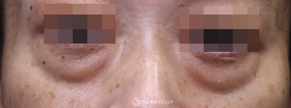 【50代女性・大きなクマをスッキリ解消】下眼瞼切開術/下眼瞼除皺術/ハムラ法（術後1ヶ月） Before 