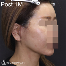 【40代女性・フェイスラインをスッキリ小顔に】フェイスリフト＋リガメント処理＋脂肪吸引（あご）（術後1ヶ月） After 