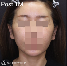【40代女性・フェイスラインをスッキリ小顔に】フェイスリフト＋リガメント処理＋脂肪吸引（あご）（術後1ヶ月） After 